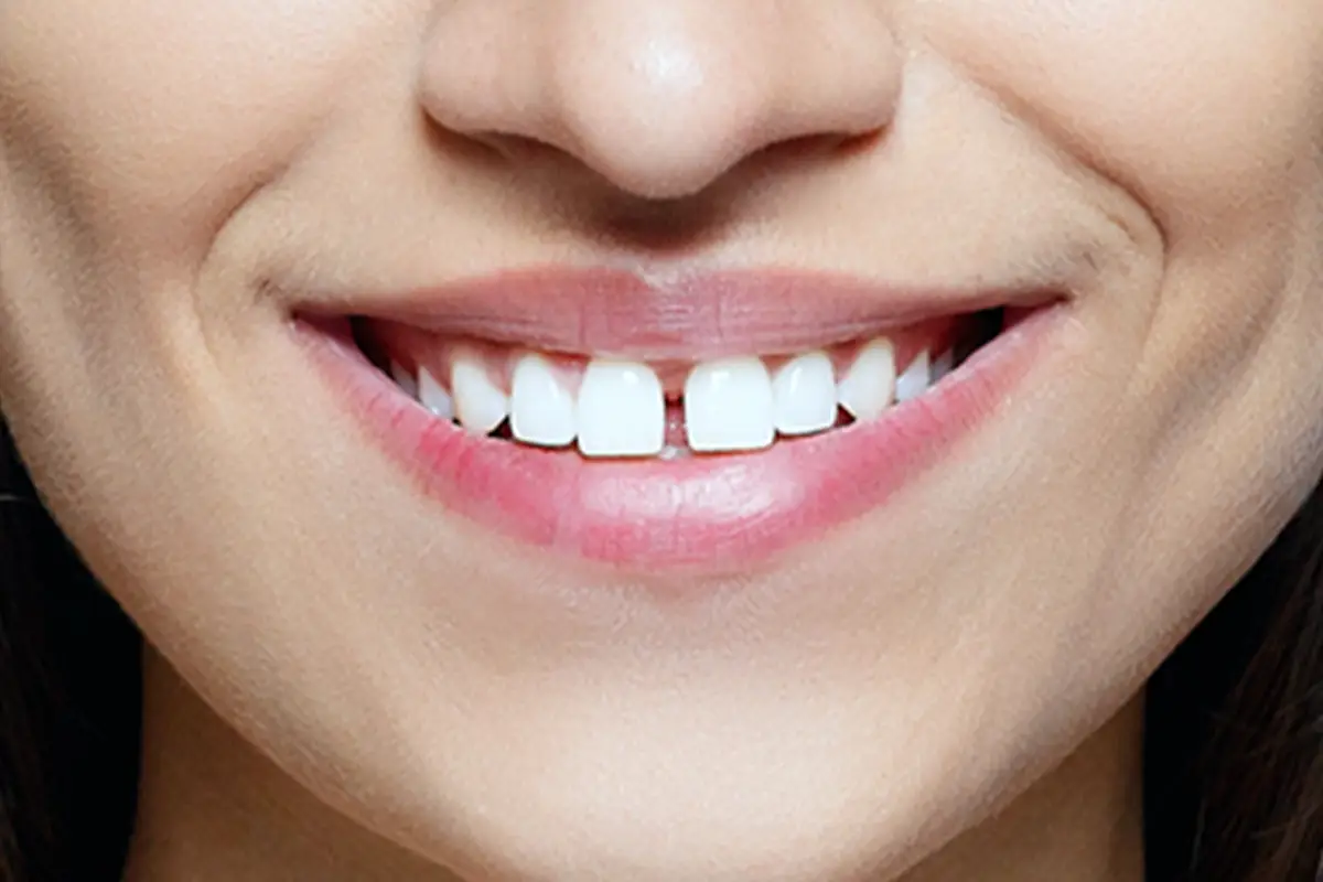 Discrete Teeth: Gaps in Your Smile